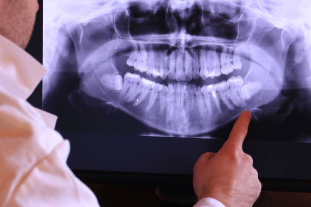 Best Emergency Treatment for Dental Infections or Abscesses in Schaumburg, IL