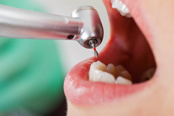 Best Urgent Care for Lost Fillings or Crowns in Schaumburg, IL
